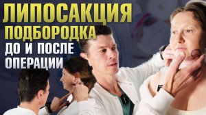Выполняю липосакцию подбородка / Ультразвуковая липосакция подбородка: до и сразу после / Vaser