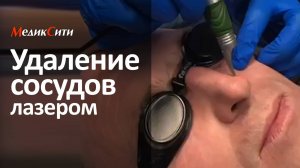 Удаление сосудов лазером. Клиника "МедикСити"