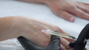 Терапия аутологичной плазмой (плазмотерапия, плазмолифтинг)