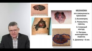 Ранняя диагностика, скрининг и профилактика меланомы и рака кожи  (к.м.н. Полежаев Д.А.)