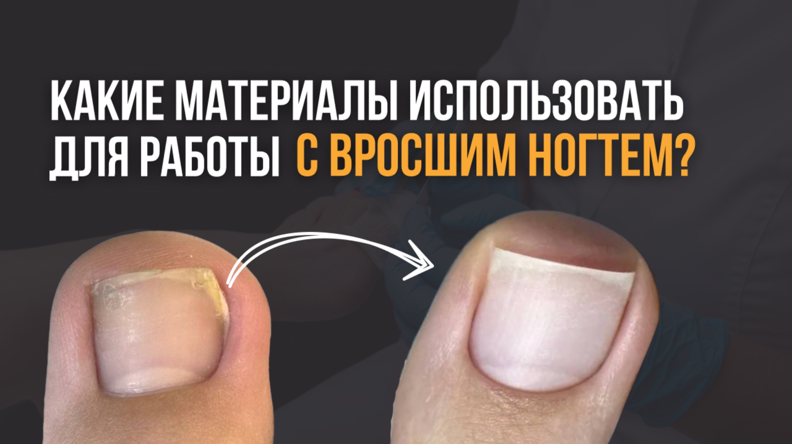 Какие материалы использовать для работы с вросшим ногтем? #вросшийноготь #тампонада #антисептик