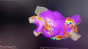 Радиочастотная изоляция лёгочных вен у пациента с фибрилляцией предсердий после крио