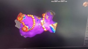 РЧА при фибрилляции предсердий (ФП)