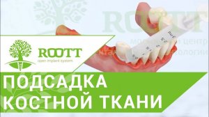 Кюретаж десен. Открытый кюретаж пародонтальных карманов десен. Стоматология ROOTT