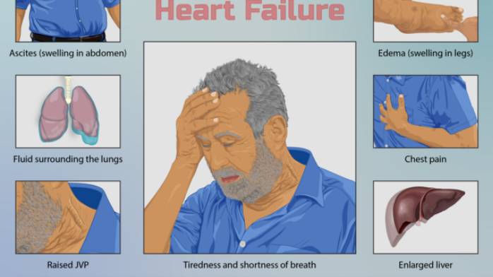 Хроническая Сердечная Недостаточность (ХСН) - Этиология, Патогенез, Клиника, Диагностика, Лечение смотреть онлайн