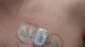 Нарушение Атриовентрикулярной Проводимости - Этиология, Патогенез, Клиника, Диагностика, Лечение