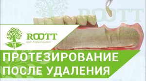 Съемное протезирование. Частично съемное протезирование после удаления зуба. ROOTT.