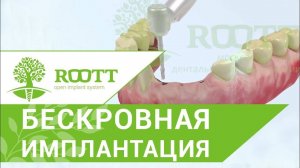 Имплантация зубов без разреза десны. Этапы имплантации зубов без разреза десны. ROOTT.