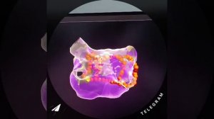 Аблация фибрилляции предсердий и атипичного трепетания предсердий