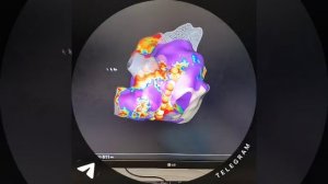 Антральная радиочастотная изоляция лёгочных вен после ранее выполненной лассо-аблации в 2008 году