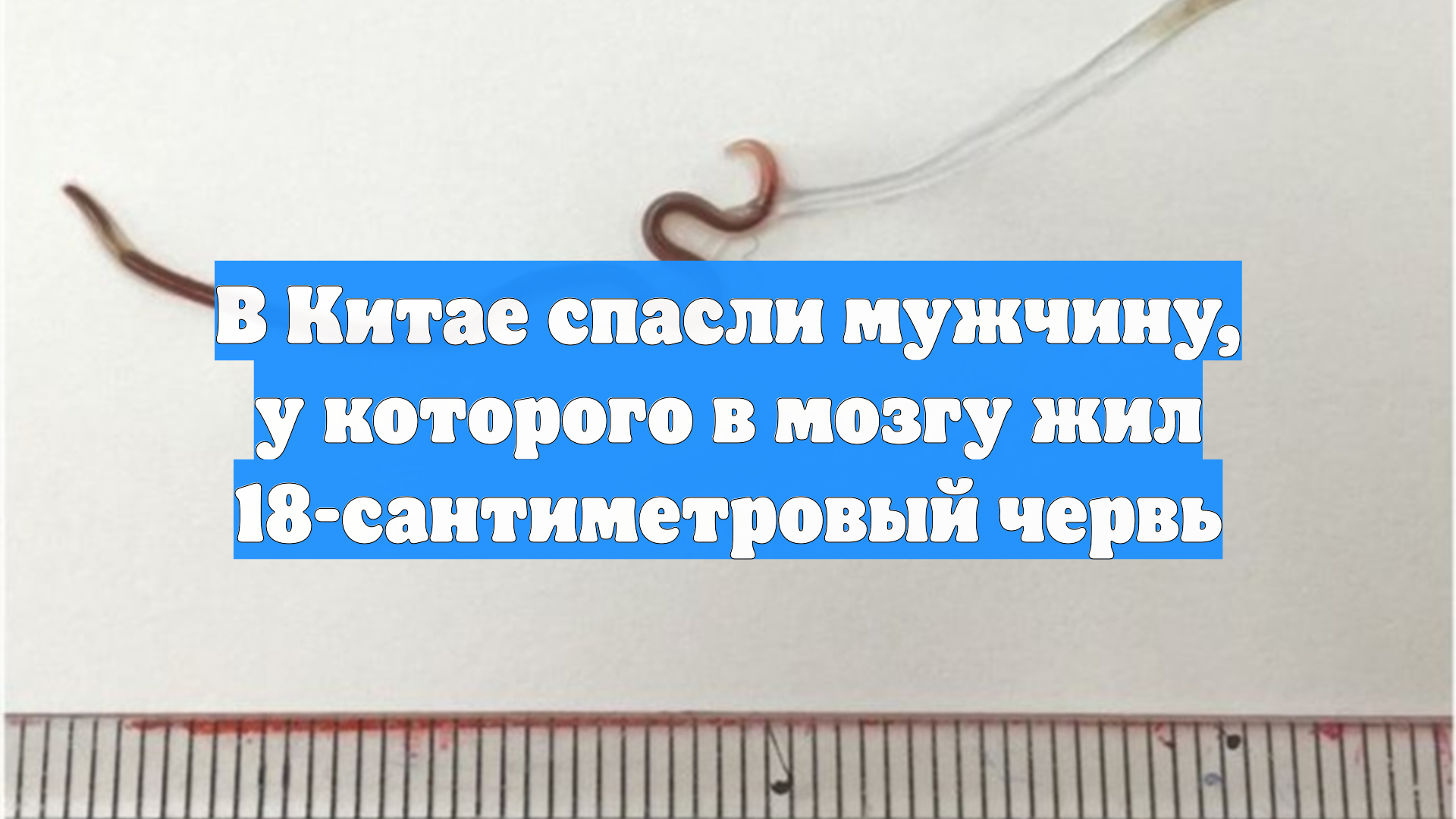 В Китае спасли мужчину, у которого в мозгу жил 18-сантиметровый червь
