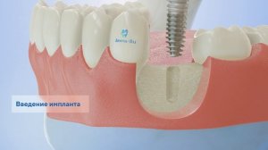 Информационный 3d ролик - имплантация