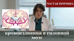 Частая причина кровоизлияния в головной мозг
