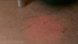 Лазерная эпиляция