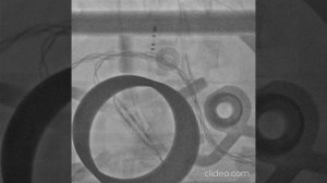 Доставки электродов в полость сердца через систему нижней полой вены