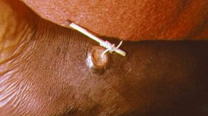 Ришта (Dracunculus medinensis) - Морфология, Жизненный Цикл, Диагностика, Лечение, Профилактика