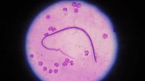 Вухерерия (Wuchereria bancrofti) - Жизненный Цикл, Размеры, Симптомы, Диагностика, Профилактика