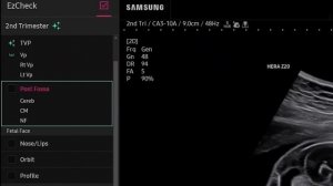 Ультразвуковой аппарат с искусственным интеллектом Live ViewAssist от Samsung
