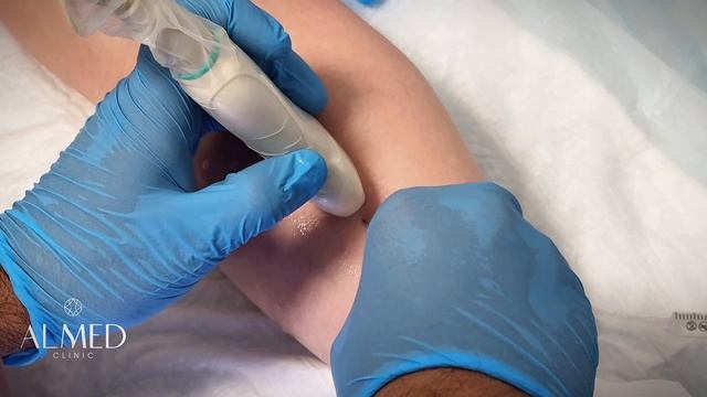 СКЛЕРОТЕРАПИЯ