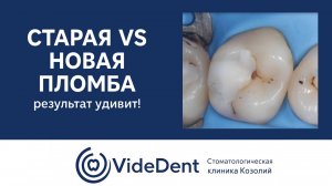 Старая vs новая пломба — результат удивит!