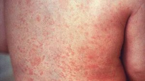 КРАСНУХА_ симптомы, лечение и профилактика, что СКРЫВАЮТ от нас _ микробиология