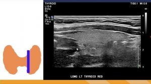 Щитовидная железа - лекция для врачей УЗИ, техника выполнения 3 (сон)