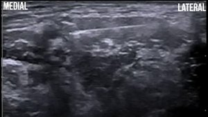 Межлестничная блокада