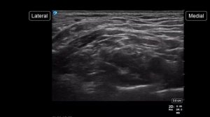 3-минутный гайд БПС надключичным доступом