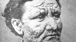 Лепра (Mycobacterium leprae) Морфология, Патогенез, Клиника, Лабораторная Диагностика и Профилактика