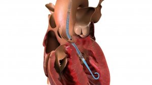 В 10 раз больше дней жизни при кардиогенном шоке с Impella CP (микроаксиальный проточный насос)!!!