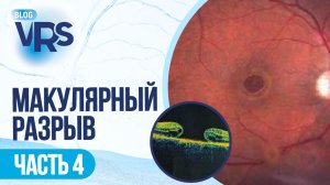 Макулярный разрыв /часть 4