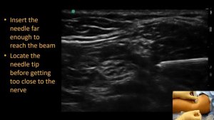 Popliteal Sciatic Block - In-plane Approach #1 ('Block Bytes') Переведено