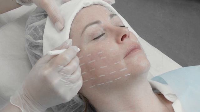 Mастер-класс на препарате PLINEST. Работа с отечно-деформационным типом старения. смотреть онлайн