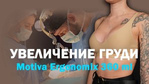 Увеличение груди у Петрова: Motiva 360 мл и результат через 3 месяца
