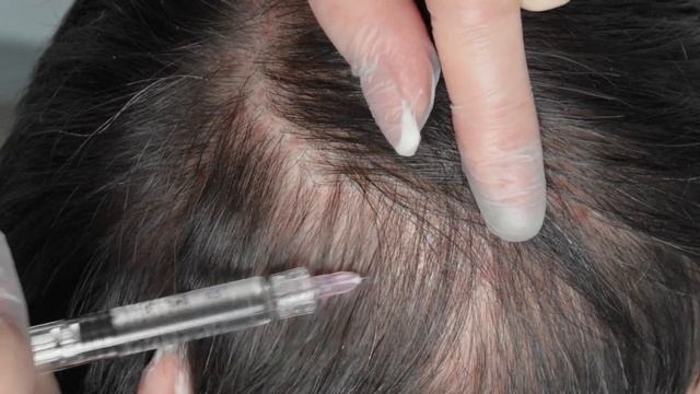 PLINEST fast Трихология смотреть онлайн