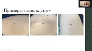Ранняя диагностика меланомы. Так ли страшен чёрт...