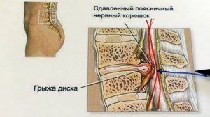 Лечение грыжи позвоночника без операции - как это дела