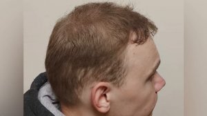 5 месяцев спустя! Второй этап пересадки показывает отличную динамику!