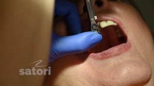 Как мы это делаем: 5 коронок только на 3 импланта