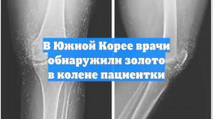 В Южной Корее врачи обнаружили золото в колене пациентки