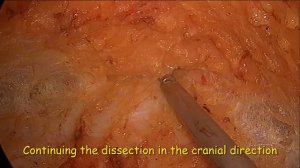 Эндоскопическая пластика диастаза прямых мыщц живота