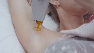 Лазерная эпиляция