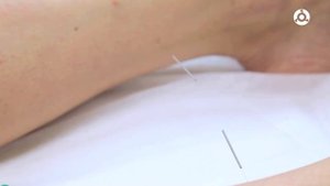 Традиционная китайская медицина – Иглорефлексотерапия