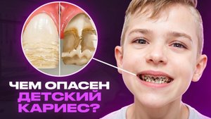 КАК ЧИСТИТЬ МОЛОЧНЫЕ ЗУБЫ? КАРИЕС У ДЕТЕЙ - ЧТО ДЕЛАТЬ?
