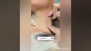 Отзыв на процедуру удаления родинки