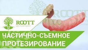 Частично съемное протезирование после удаления зуба. Частично съемное протезирование. ROOTT