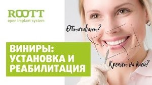 Установка виниров для зубов. Ответы на вопросы по зубным винирам. Часть 2