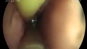 Эндоскопическая установка Т-образной трубки при перфорации пищевода, вызванной щелочью