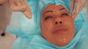 Нитевой лифтинг нитями APTOS