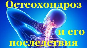 Остеохондроз и его последствия для современного человека Здоровье
